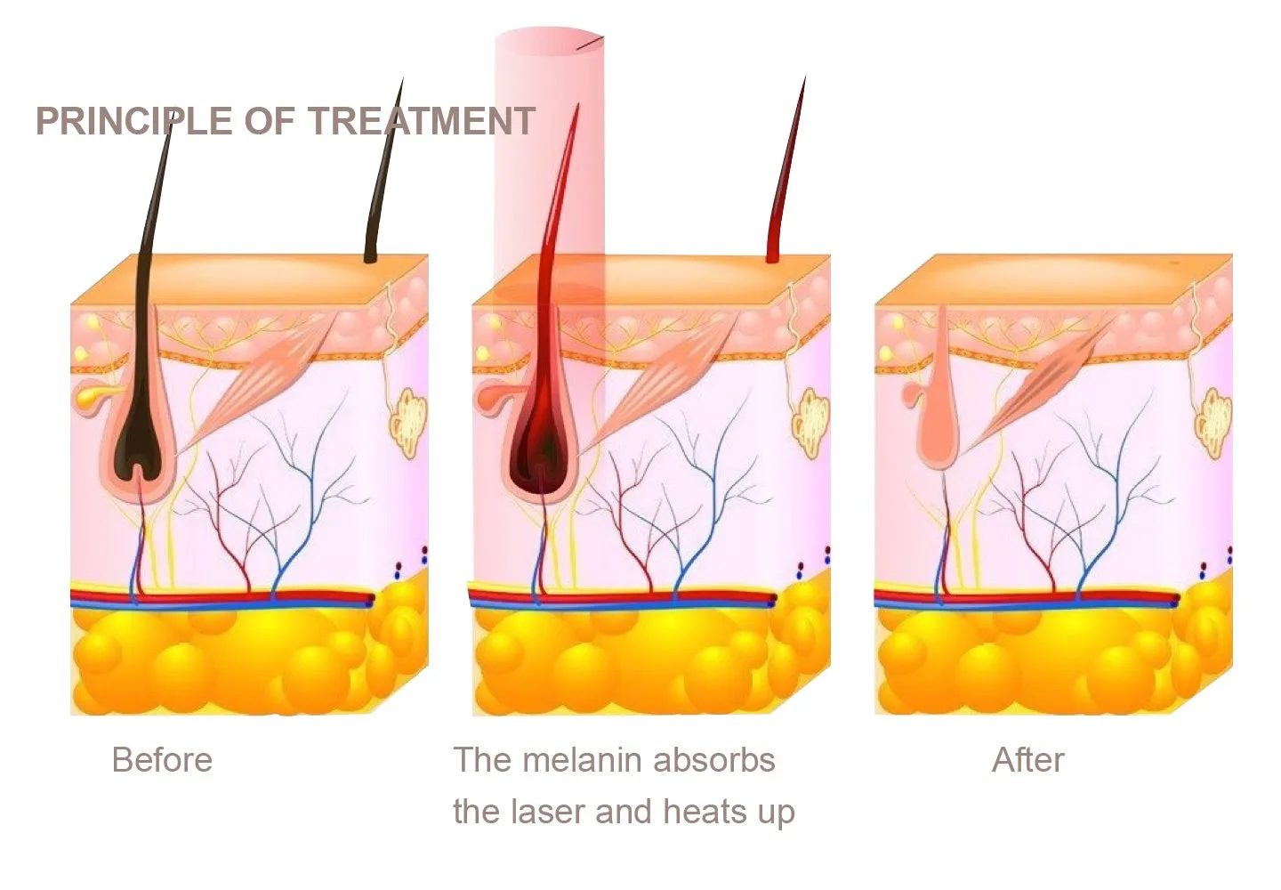InviSmooth Luxury Diode Laser (4 Wavelengths, Flexible Spot Size)